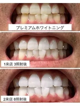 プレミアムホワイトニング