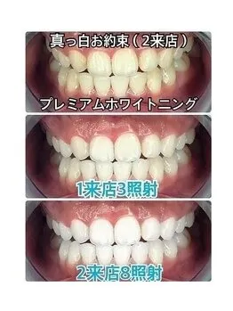 歯の黄ばみの原因とは?その1 草加 越谷 川口 足立の安いホワイトニングならライトビューティー草加駅店
